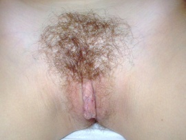 hairy-pubic-mound